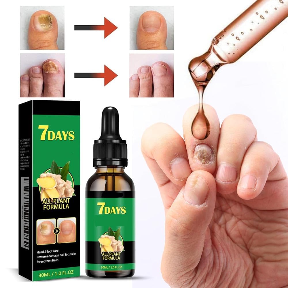 Treat Fingernail and Toenail Fungus in Just 7 Days!